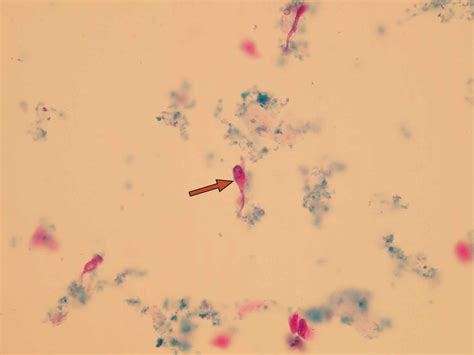 Epithelial Cells In Urine