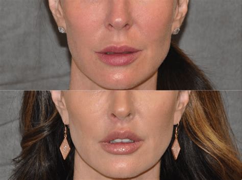 Lip Lift Surgery | Celebrity plastic surgery, Lip surgery, Eyebrow grooming