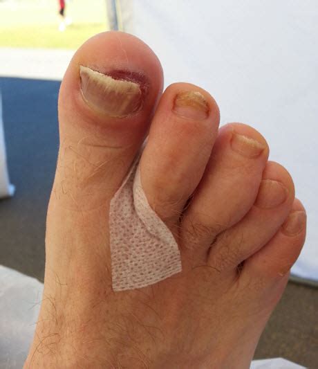 Black Toenail Treatment, Causes & Prevention - Blister Prevention