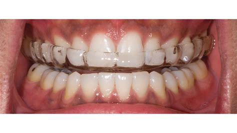 https://images.glidewelldental.com/2014/12/cm0103-occlusal-splint-06.jpg