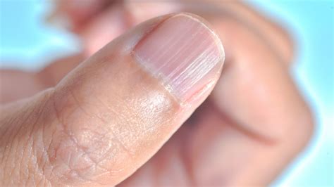 Fingernail Ridges: Causes And Treatments For Vertical And Horizontal Nail Lines