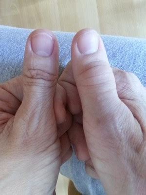 Rheumatoid Disease Thriller: Mystery of the Injured Thumb | Rheumatoid Arthritis Warrior | The ...