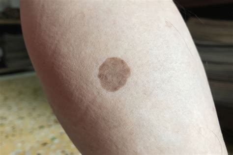 Diabetic Dermopathy (Shin Spots): Treatment, Symptoms, and Causes