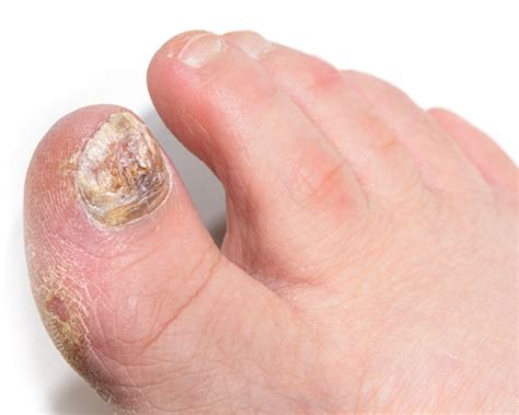 Fungal nail infections | Signs Causes Do's & Don'ts