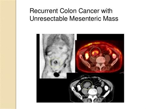 Radiation for Colon and Rectal Cancer