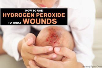 How To Treat Wounds With Hydrogen Peroxide?