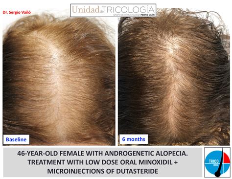 MINOXIDIL ORAL EN ALOPECIA ANDROGÉNICA (2022)