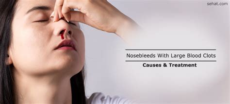Nosebleeds With Large Blood Clots - Causes, Treatment, When To See A Doctor