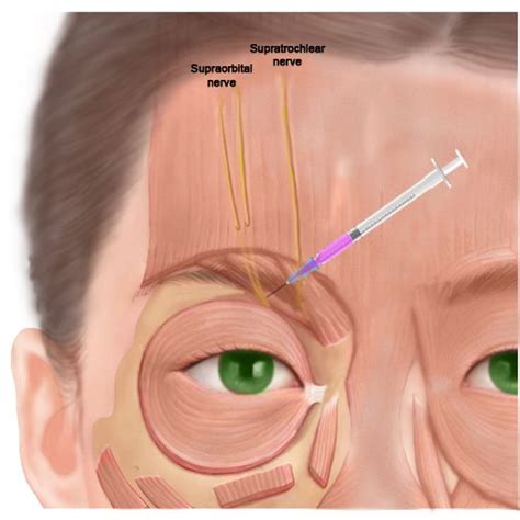 Supraorbital Nerve V1