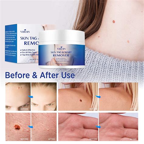 Skin Tag Remover, Warts & Mole Remover Cream- Best Skin Tag Removal Treatment, Enriched with All ...