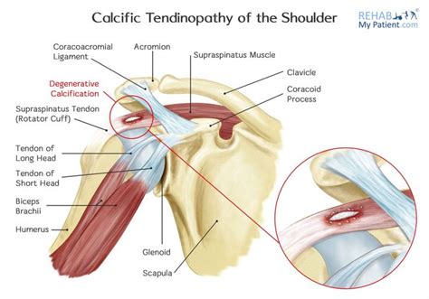 Shoulder injuries, Biceps brachii, Supraspinatus muscle