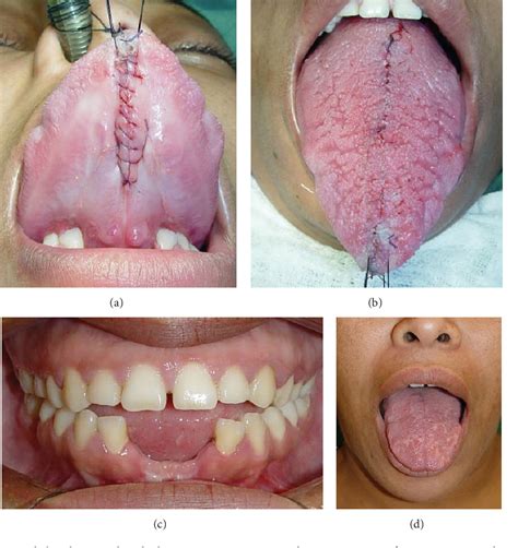 Figure 3 from Surgical Treatment of Congenital True Macroglossia | Semantic Scholar