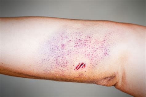 Petechiae vs. Purpura: Skin Discoloration and Your Health