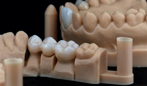 What is a Dental Bridge? Types and Benefits