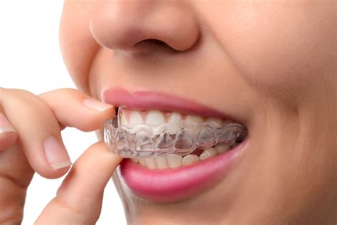 Does Insurance Cover Invisalign? The Basics Explained - Yuba City ...