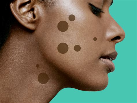 9 Dark Spot Treatments That Really Work, According to Dermatologists | SELF