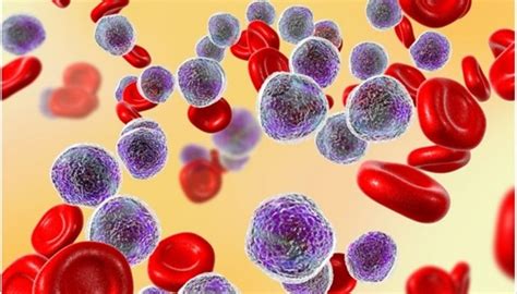 Nuevos avances sobre el origen de la leucemia linfoblástica aguda en ...