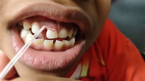 How to pull your teeth out with a piece of string - YouTube