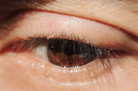 What Happens if Blepharitis Is Left Untreated? | Toronto, ON