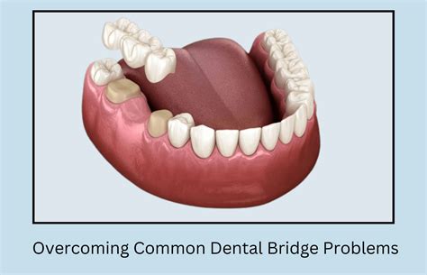 A Guide to Overcoming Common Dental Bridge Problems - Oral Health Line