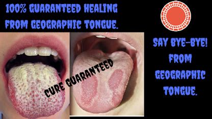 BURNING TONGUE TREATMENT |GEOGRAPHIC TONGUE CURE | 100% GUARANTEED ...