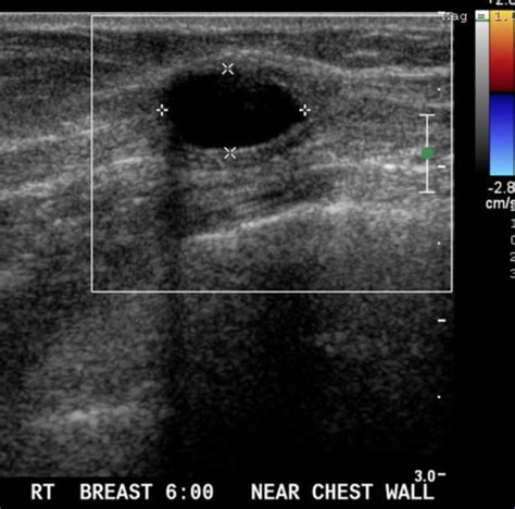 Figure 3 from Epidermoid cyst of the breast: Mammography, ultrasound, MRI | Semantic Scholar