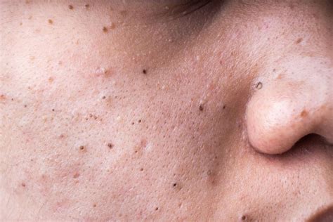 Does Accutane Get Rid of Blackheads? Best Guide for 2021