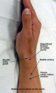 Radial Nerve Block: Overview, Indications, Contraindications