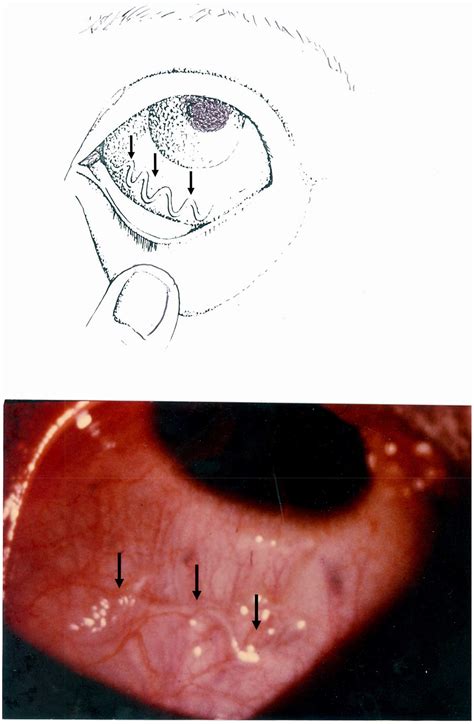 Illustration of the passage of an adult worm (Loa loa) across the ...