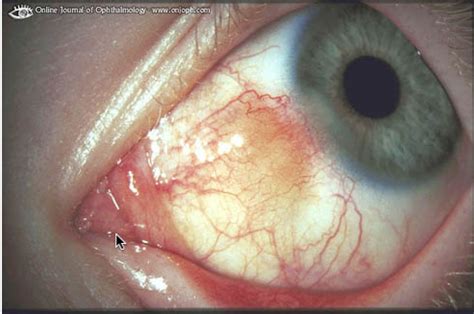 Renal Fellow Network: Scleritis and Kidney Disease - More than meets ...