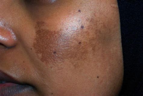 Melasma (Mask of Pregnancy): Symptoms, Diagnosis, and Treatments