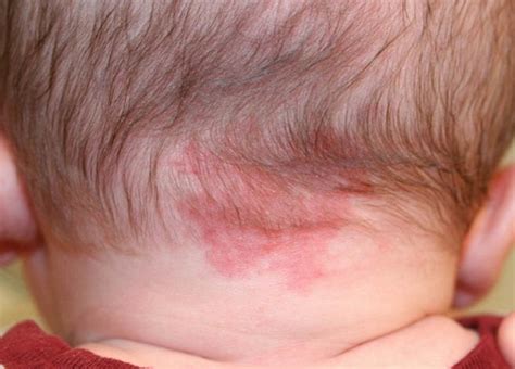 Strawberry Nevus and Other Birthmarks in Pictures | Med-Health.net