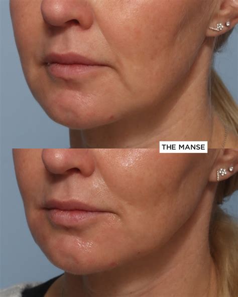 Dermal Filler for Jowls and Marionette Folds - Best Cosmetic Clinic Sydney. Advanced practitioners