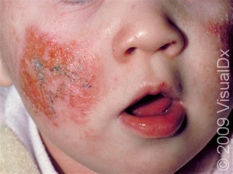 Eczema (Atopic Dermatitis) Condition, Treatments and Pictures for ...