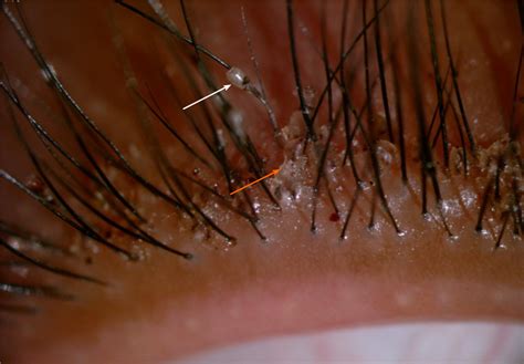 Crab lice infestation in unilateral eyelashes and adjacent eyelids: A case report