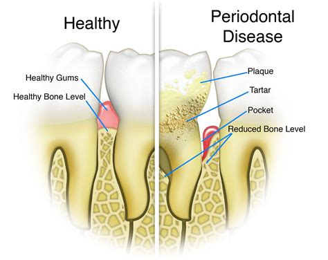 Gum Disease - Laurich Dentistry