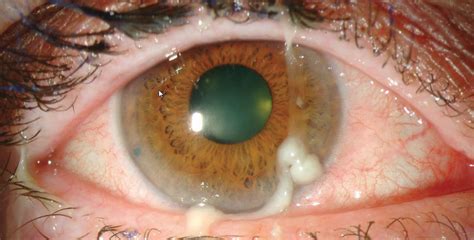 Purulent Conjunctivitis