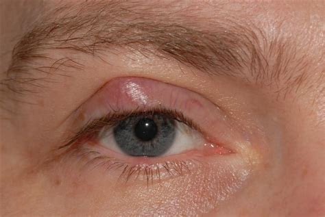 Bump on Eyelid - Causes, Symptoms, Treatment, Prevention | HealthMD