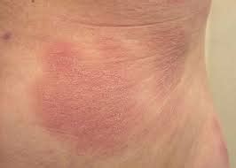 Cutaneous T Cell Lymphoma Skin Rash