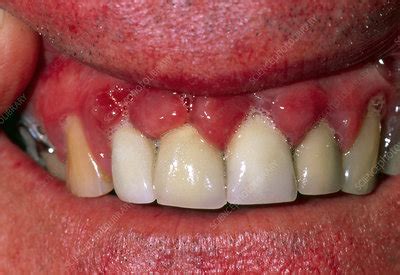 Hyperplasia of the gums due to the drug nifedipine - Stock Image - M170 ...