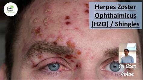 Herpes Zoster Ophthalmicus