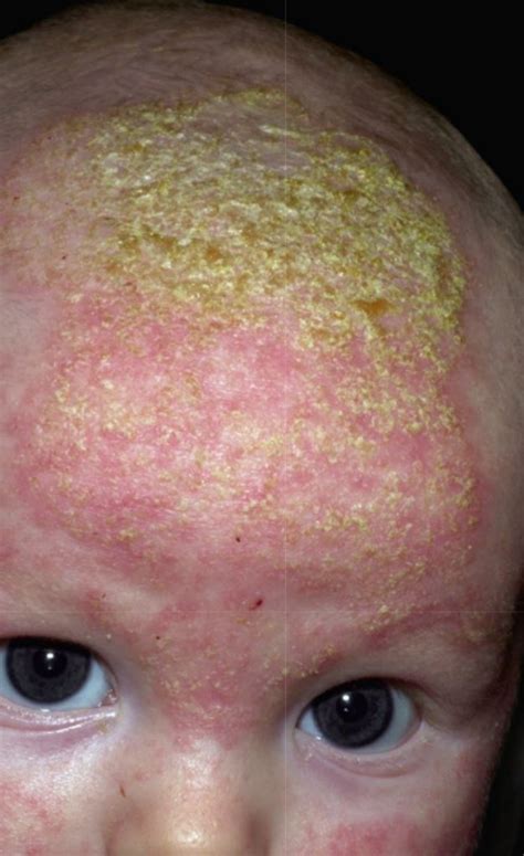 Seborrheic Dermatitis Scalp Infant