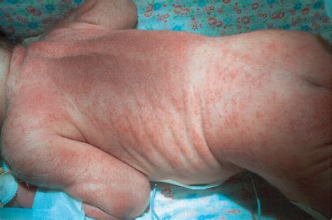 Congenital candidiasis presenting as septic shock without rash | BMJ Case Reports