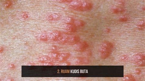 APA ITU KUDIS BUTA (SCABIES) ? Ubat dan Cara Merawat Kudis Buta | APA ITU KUDIS BUTA (SCABIES ...