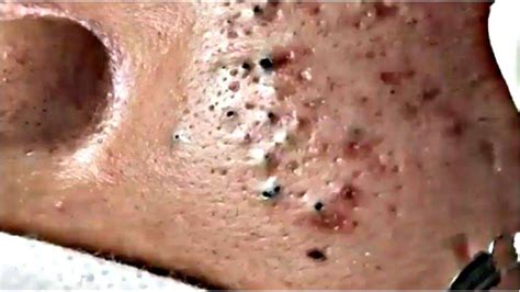 How to Removal Blackheads,Whiteheads #68 - YouTube