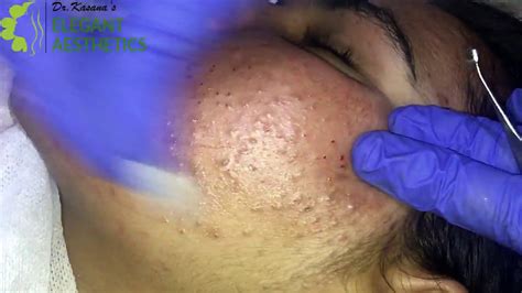 COMEDONES REMOVAL PART 1 by POPPING KING DR.LALIT KASANA - YouTube