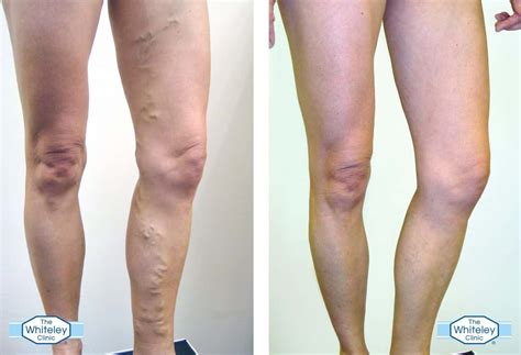 Identifying Varicose Veins