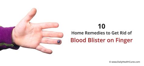 Blood Blister on Finger: 10 Effective Home Remedies That Can Help