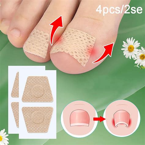 Ingrown Toenail Correction Anti Paronychia Treatment Toe Nail Sticker Foot Care Pedicure Foot ...