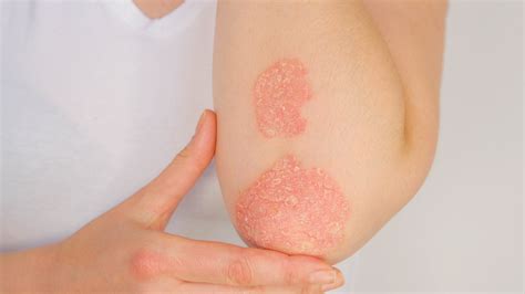 7 Early Signs of Psoriatic Arthritis - Healthcare Associates of Texas